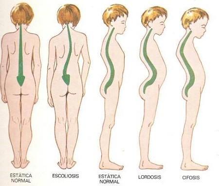 desaroollo columna vertebral niño correcto y desviado