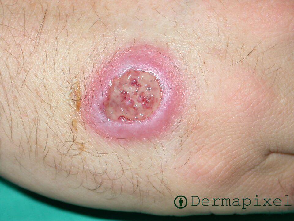 Leishmaniasis 3