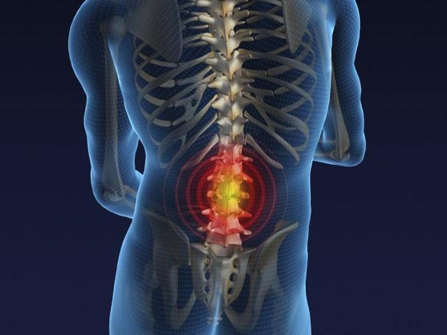 hernia discal L5-S1 causas