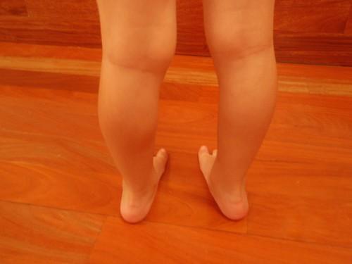 Hiperextensión de las rodillas