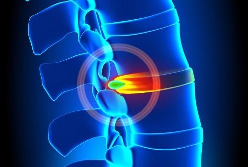 inzitan hernia discal