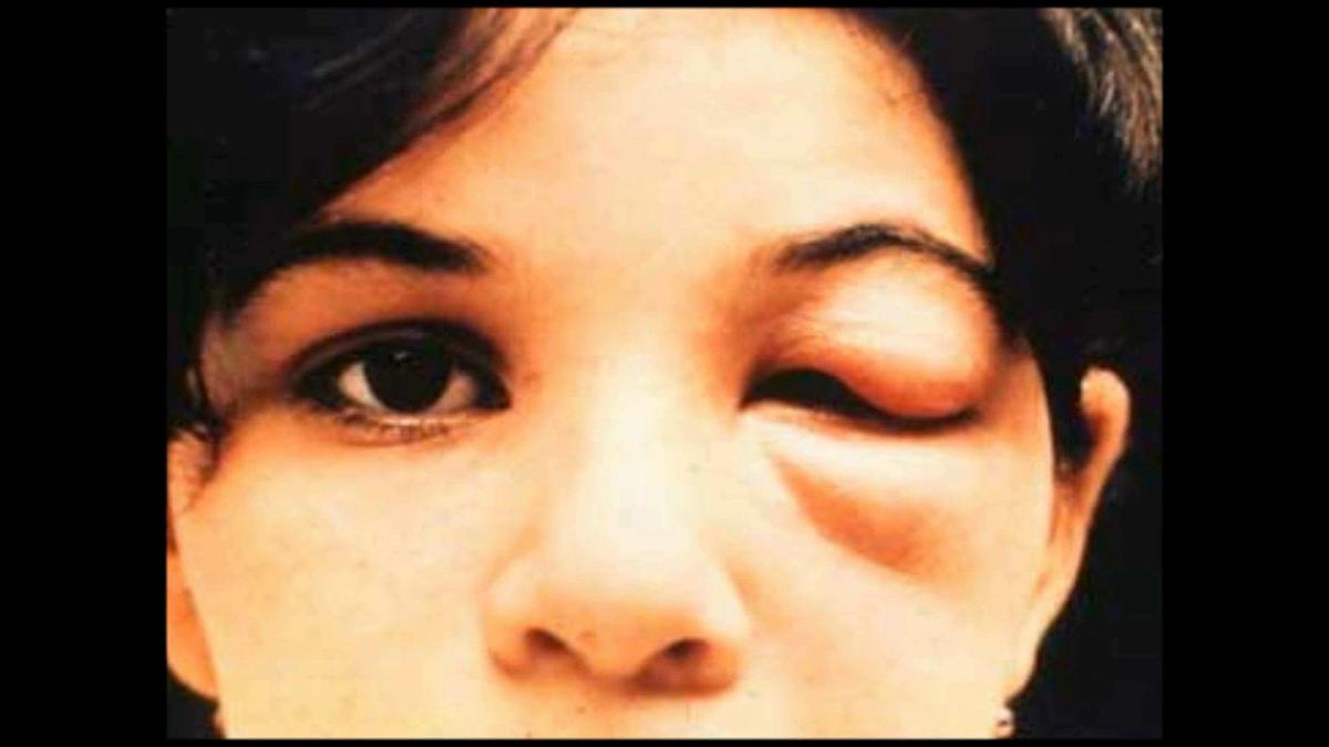 Enfermedad de Chaga 4