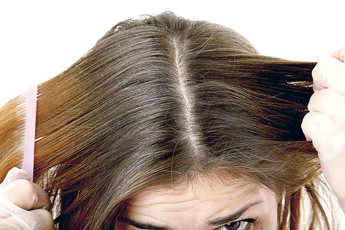 caspa en el cabello