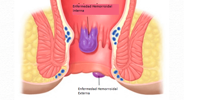 Enfermedad hemorroidal