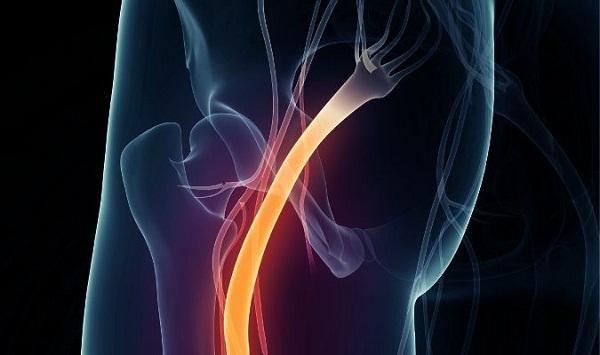 Otros síntomas para aliviar con Inzitan ciática