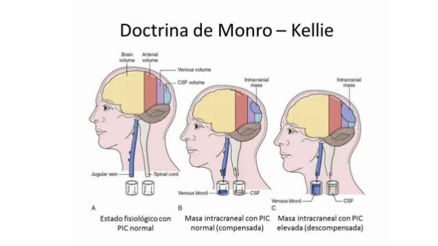 PIC: Presión intracraneal