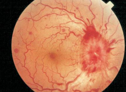 Hipertensión endocraneana 3