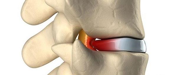 hernia discal