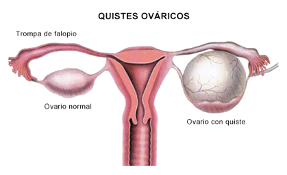 quistes-ovaricos