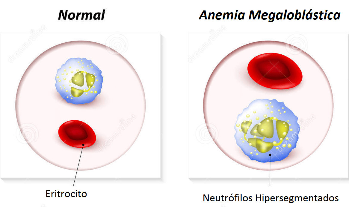 Anemias megaloblásticas