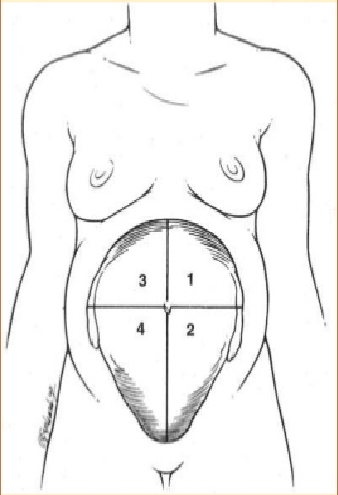 División del abdomen materno en cuatro cuadrantes para mediar el ILA