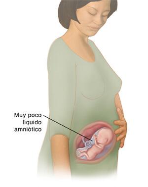 Alteraciones del líquido amniótico 3