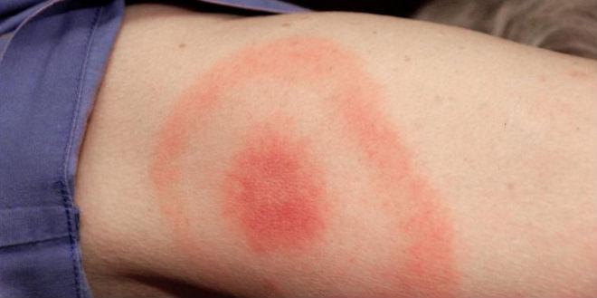 enfermedad de lyme