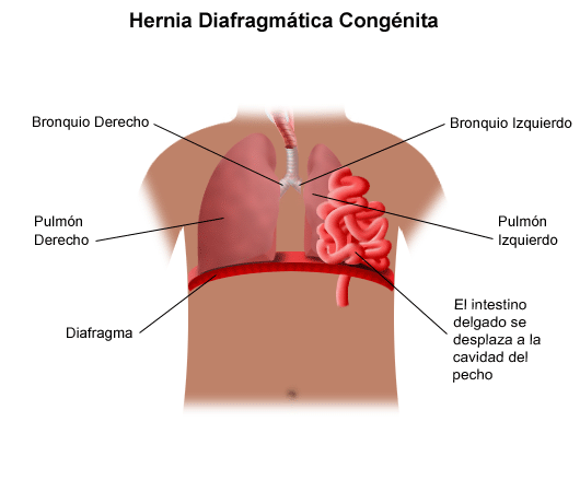 Hernia diafragmática congénita