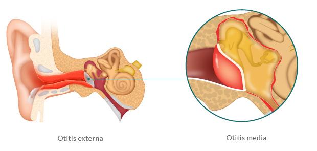 otitis externa