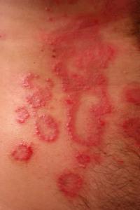 Eczema, arcilla