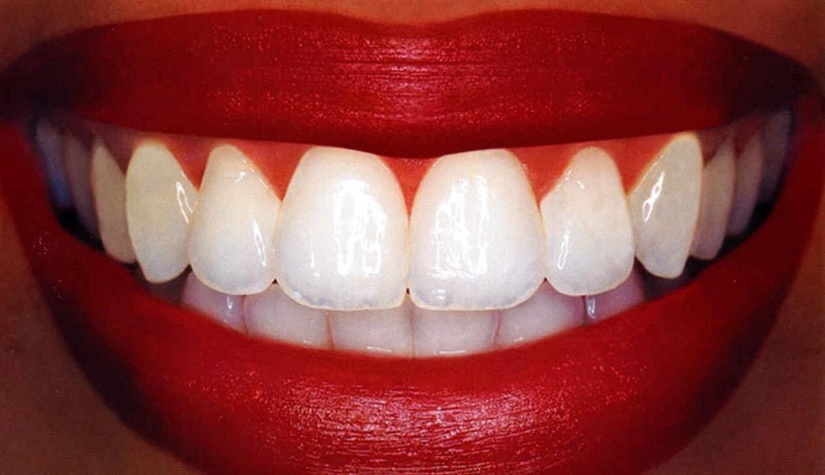 dientes-blancos