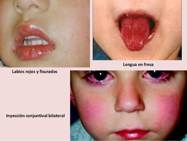 enfermedad-de-kawasaki-11-638