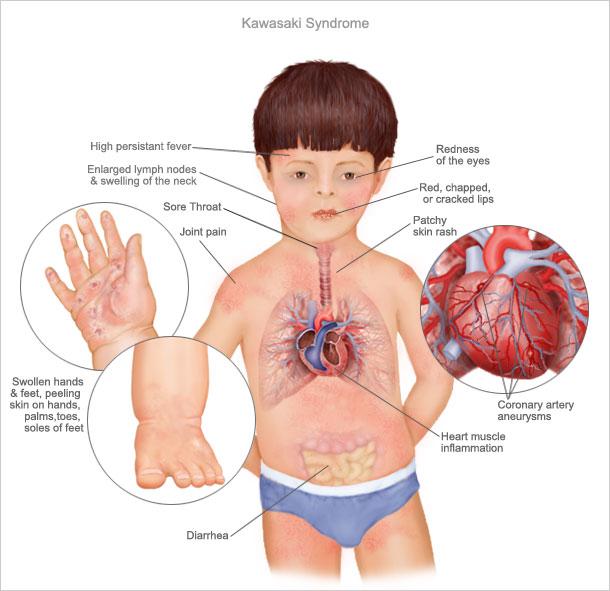 enfermedad de kawasaki