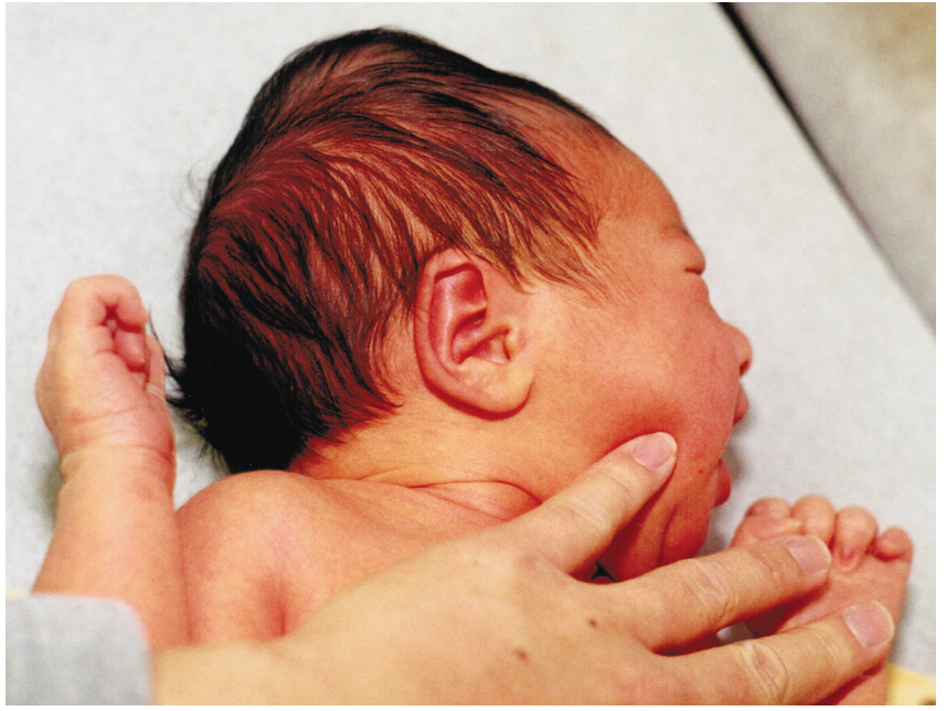 Traumatismos de parto 4