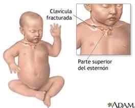 Traumatismos de parto 2