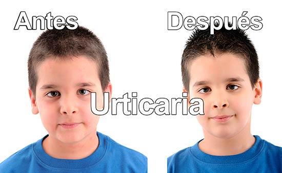 urticaria 