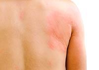urticaria 