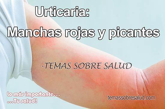 urticaria 