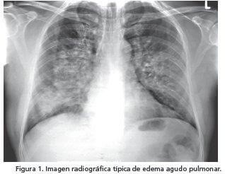 Edema agudo de pulmón 2