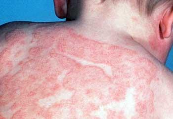 manifestaciones clinicas de la dermatitis atopica