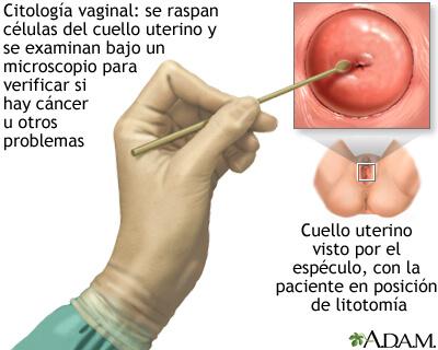 cáncer de cuello uterino