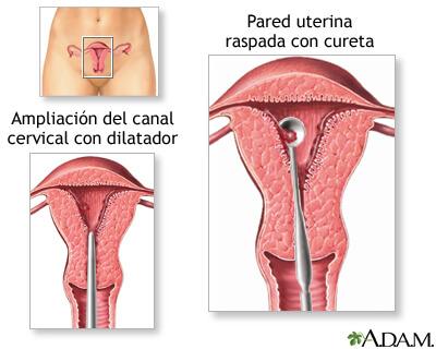 cáncer de cuello uterino