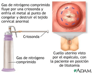 cáncer de cuello uterino