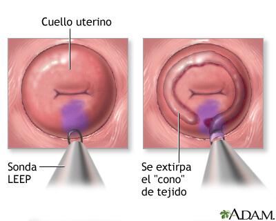 cáncer de cuello uterino