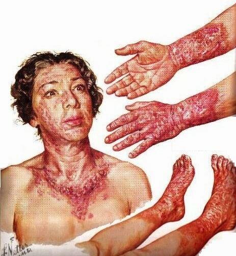 deficiencia de vitamina B