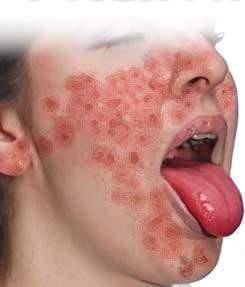 deficiencia de vitamina B