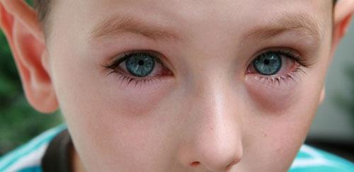 deficiencia de vitamina B