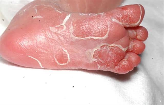 manifestaciones clinicas de la sífilis