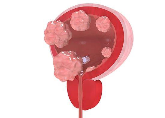 cáncer de vejiga