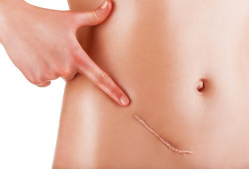 causas de la peritonitis