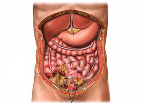 causas de la peritonitis