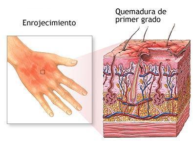 como tratar las quemaduras