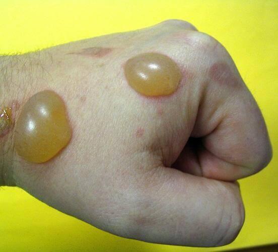 quemaduras de segundo grado.!