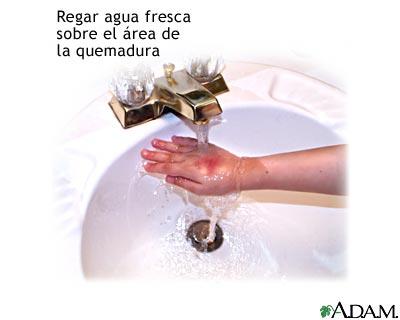 como tratar las quemaduras