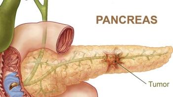 Cáncer de páncreas