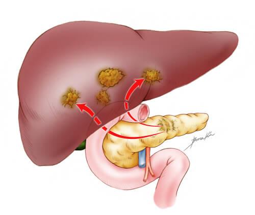 cáncer de páncreas