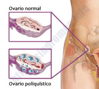 ¿Que es el Síndrome de Ovario Poliquístico?