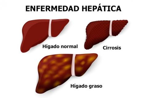 hepatitis en niños