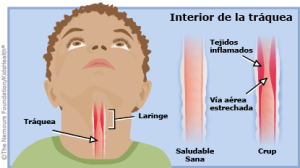 infecciones del tracto respiratorio superior