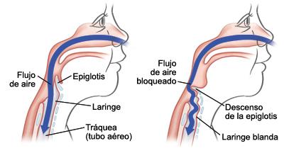 infecciones del tracto respiratorio superior